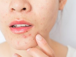 About Your Clogged Pores | Glow Bright Med Spa