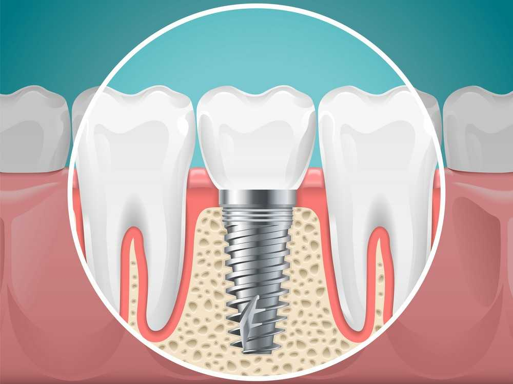 best dental implants in Agoura Hills