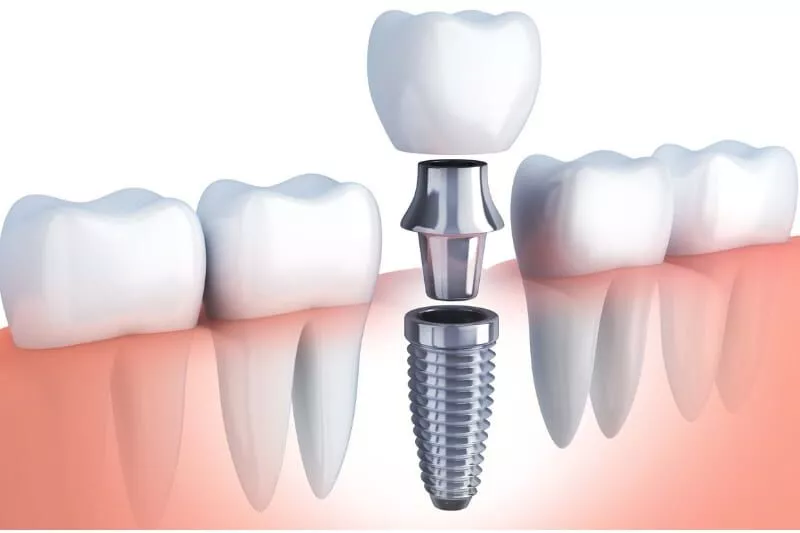 affordable dental implants in Agoura Hills