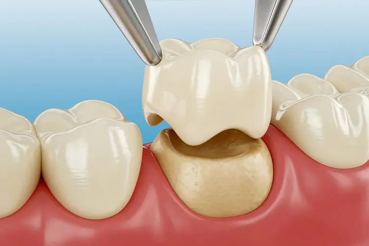 Zirconia crowns