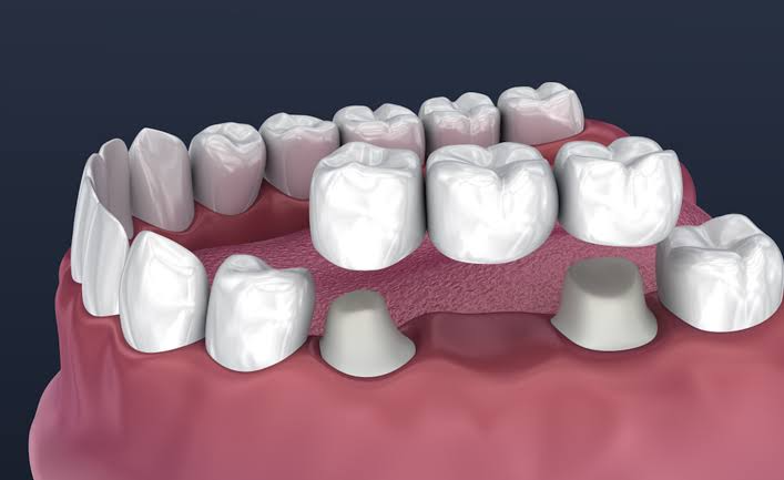 Dental Crown
