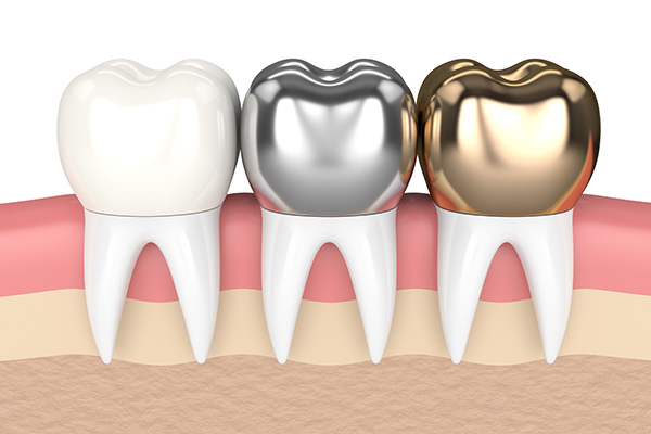 Gold and metal alloy crowns
